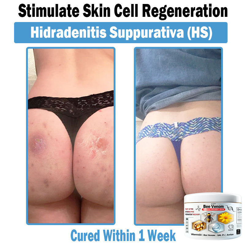 BEE 𝑽𝒆𝒏𝒐𝒎 𝑴𝒖𝒍𝒕𝒊-𝑺𝒚𝒎𝒑𝒕𝒐𝒎 𝑺𝒌𝒊𝒏 𝑻𝒓𝒆𝒂𝒕𝒎𝒆𝒏𝒕 𝑪𝒓𝒆𝒂𝒎  (TLOPA®  👨‍⚕𝑵𝑷𝑭 𝑹𝑬𝑪𝑶𝑴𝑴𝑬𝑵𝑫𝑺🏅)