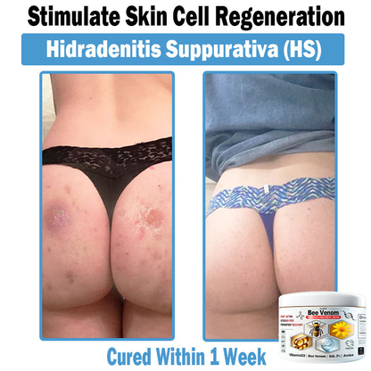 BEE 𝑽𝒆𝒏𝒐𝒎 𝑴𝒖𝒍𝒕𝒊-𝑺𝒚𝒎𝒑𝒕𝒐𝒎 𝑺𝒌𝒊𝒏 𝑻𝒓𝒆𝒂𝒕𝒎𝒆𝒏𝒕 𝑪𝒓𝒆𝒂𝒎  (TLOPA®  👨‍⚕𝑵𝑷𝑭 𝑹𝑬𝑪𝑶𝑴𝑴𝑬𝑵𝑫𝑺🏅)