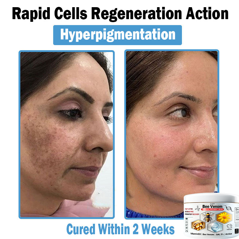 BEE 𝑽𝒆𝒏𝒐𝒎 𝑴𝒖𝒍𝒕𝒊-𝑺𝒚𝒎𝒑𝒕𝒐𝒎 𝑺𝒌𝒊𝒏 𝑻𝒓𝒆𝒂𝒕𝒎𝒆𝒏𝒕 𝑪𝒓𝒆𝒂𝒎  (TLOPA®  👨‍⚕𝑵𝑷𝑭 𝑹𝑬𝑪𝑶𝑴𝑴𝑬𝑵𝑫𝑺🏅)