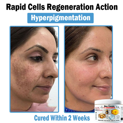 BEE 𝑽𝒆𝒏𝒐𝒎 𝑴𝒖𝒍𝒕𝒊-𝑺𝒚𝒎𝒑𝒕𝒐𝒎 𝑺𝒌𝒊𝒏 𝑻𝒓𝒆𝒂𝒕𝒎𝒆𝒏𝒕 𝑪𝒓𝒆𝒂𝒎  (TLOPA®  👨‍⚕𝑵𝑷𝑭 𝑹𝑬𝑪𝑶𝑴𝑴𝑬𝑵𝑫𝑺🏅)