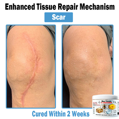 BEE 𝑽𝒆𝒏𝒐𝒎 𝑴𝒖𝒍𝒕𝒊-𝑺𝒚𝒎𝒑𝒕𝒐𝒎 𝑺𝒌𝒊𝒏 𝑻𝒓𝒆𝒂𝒕𝒎𝒆𝒏𝒕 𝑪𝒓𝒆𝒂𝒎  (TLOPA®  👨‍⚕𝑵𝑷𝑭 𝑹𝑬𝑪𝑶𝑴𝑴𝑬𝑵𝑫𝑺🏅)