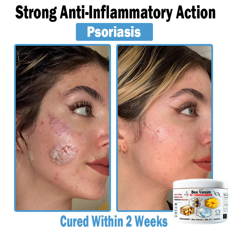 BEE 𝑽𝒆𝒏𝒐𝒎 𝑴𝒖𝒍𝒕𝒊-𝑺𝒚𝒎𝒑𝒕𝒐𝒎 𝑺𝒌𝒊𝒏 𝑻𝒓𝒆𝒂𝒕𝒎𝒆𝒏𝒕 𝑪𝒓𝒆𝒂𝒎  (TLOPA®  👨‍⚕𝑵𝑷𝑭 𝑹𝑬𝑪𝑶𝑴𝑴𝑬𝑵𝑫𝑺🏅)