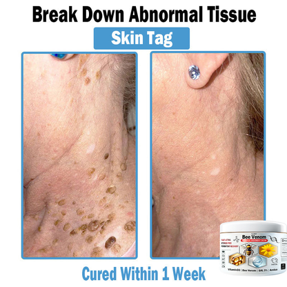 BEE 𝑽𝒆𝒏𝒐𝒎 𝑴𝒖𝒍𝒕𝒊-𝑺𝒚𝒎𝒑𝒕𝒐𝒎 𝑺𝒌𝒊𝒏 𝑻𝒓𝒆𝒂𝒕𝒎𝒆𝒏𝒕 𝑪𝒓𝒆𝒂𝒎  (TLOPA®  👨‍⚕𝑵𝑷𝑭 𝑹𝑬𝑪𝑶𝑴𝑴𝑬𝑵𝑫𝑺🏅)