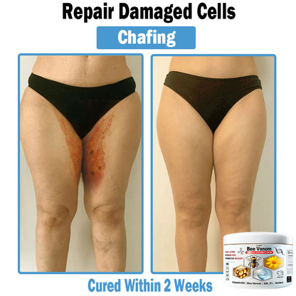 BEE 𝑽𝒆𝒏𝒐𝒎 𝑴𝒖𝒍𝒕𝒊-𝑺𝒚𝒎𝒑𝒕𝒐𝒎 𝑺𝒌𝒊𝒏 𝑻𝒓𝒆𝒂𝒕𝒎𝒆𝒏𝒕 𝑪𝒓𝒆𝒂𝒎  (TLOPA®  👨‍⚕𝑵𝑷𝑭 𝑹𝑬𝑪𝑶𝑴𝑴𝑬𝑵𝑫𝑺🏅)