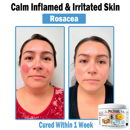 BEE 𝑽𝒆𝒏𝒐𝒎 𝑴𝒖𝒍𝒕𝒊-𝑺𝒚𝒎𝒑𝒕𝒐𝒎 𝑺𝒌𝒊𝒏 𝑻𝒓𝒆𝒂𝒕𝒎𝒆𝒏𝒕 𝑪𝒓𝒆𝒂𝒎  (TLOPA®  👨‍⚕𝑵𝑷𝑭 𝑹𝑬𝑪𝑶𝑴𝑴𝑬𝑵𝑫𝑺🏅)