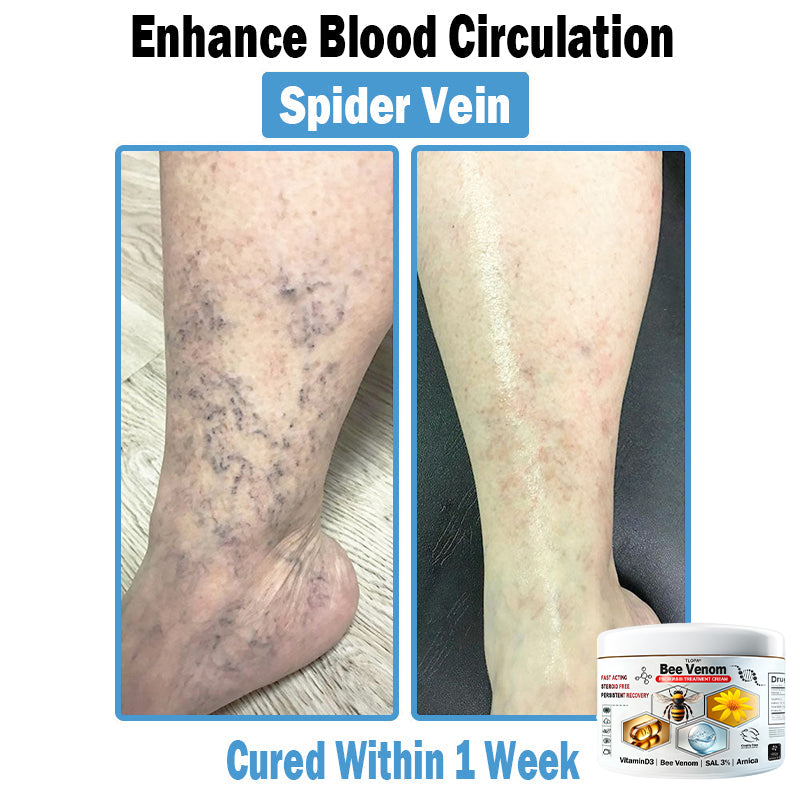 BEE 𝑽𝒆𝒏𝒐𝒎 𝑴𝒖𝒍𝒕𝒊-𝑺𝒚𝒎𝒑𝒕𝒐𝒎 𝑺𝒌𝒊𝒏 𝑻𝒓𝒆𝒂𝒕𝒎𝒆𝒏𝒕 𝑪𝒓𝒆𝒂𝒎  (TLOPA®  👨‍⚕𝑵𝑷𝑭 𝑹𝑬𝑪𝑶𝑴𝑴𝑬𝑵𝑫𝑺🏅)