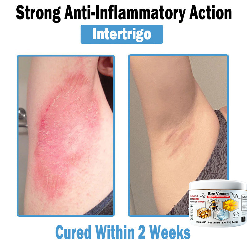 BEE 𝑽𝒆𝒏𝒐𝒎 𝑴𝒖𝒍𝒕𝒊-𝑺𝒚𝒎𝒑𝒕𝒐𝒎 𝑺𝒌𝒊𝒏 𝑻𝒓𝒆𝒂𝒕𝒎𝒆𝒏𝒕 𝑪𝒓𝒆𝒂𝒎  (TLOPA®  👨‍⚕𝑵𝑷𝑭 𝑹𝑬𝑪𝑶𝑴𝑴𝑬𝑵𝑫𝑺🏅)